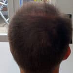 Erfolgreich Haarausfall stoppen - Report 6 - Hinterkopf hinten