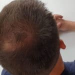 Erfolgreich Haarausfall stoppen - Report 6 - Hinterkopf links