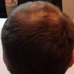 Erfolgreich Haarausfall stoppen - Report 5 - Hinterkopf hinten