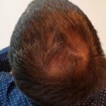 Erfolgreich Haarausfall stoppen - Report 5 - Hinterkopf oben