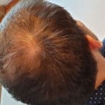 Erfolgreich Haarausfall stoppen - Report 5 - Hinterkopf rechts