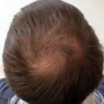 Erfolgreich Haarausfall stoppen - Report 6 - Hinterkopf oben