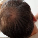 Erfolgreich Haarausfall stoppen - Report 6 - Hinterkopf rechts