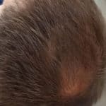 Erfolgreich Haarausfall stoppen - Report 7 - Hinterkopf rechts