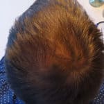 Erfolgreich Haarausfall stoppen - Report 7 - Hinterkopf hinten oben