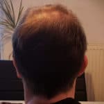 Erfolgreich Haarausfall stoppen - Report 1 - Hinterkopf hinten