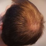 Erfolgreich Haarausfall stoppen - Report 1 - Hinterkopf links