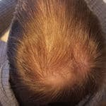 Erfolgreich Haarausfall stoppen - Report 1 - Hinterkopf oben