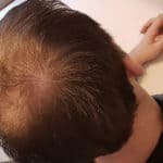 Erfolgreich Haarausfall stoppen - Report 1 - Hinterkopf rechts