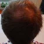 Erfolgreich Haarausfall stoppen - Report 2 - Hinterkopf hinten