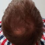 Erfolgreich Haarausfall stoppen - Report 2 - Hinterkopf oben
