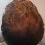 Erfolgreich Haarausfall stoppen - Report 3 - Hinterkopf hinten
