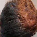 Erfolgreich Haarausfall stoppen - Report 3 - Hinterkopf links