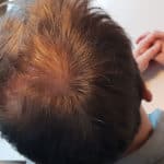 Erfolgreich Haarausfall stoppen - Report 3 - Hinterkopf rechts