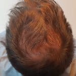Erfolgreich Haarausfall stoppen - Report 3 - Hinterkopf oben