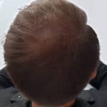 Erfolgreich Haarausfall stoppen - Report 8 - Hinterkopf oben