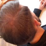 Erfolgreich Haarausfall stoppen - Report 8 - Hinterkopf rechts