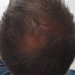 Erfolgreich Haarausfall stoppen - Report 6 - Hinterkopf oben