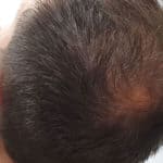 Erfolgreich Haarausfall stoppen - Report 6 - Hinterkopf rechts